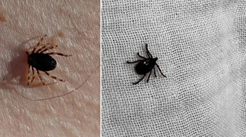 Kırıkkale'de KKKA vakası: Vücuduna yapışan keneyi çıkartan çocuğun testi pozitif çıktı