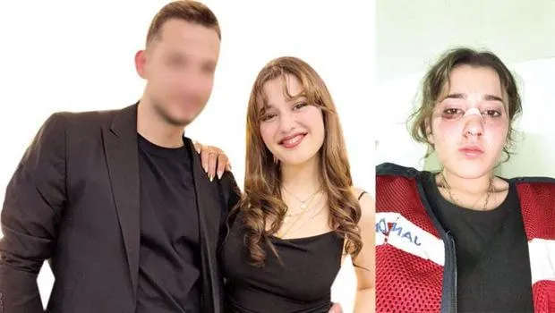 Nişanlısından Şiddet! Kaskla Darp, Yüzüne Kafa: Dehşet Anları!
